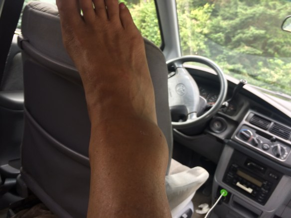 swollen ankle.JPG